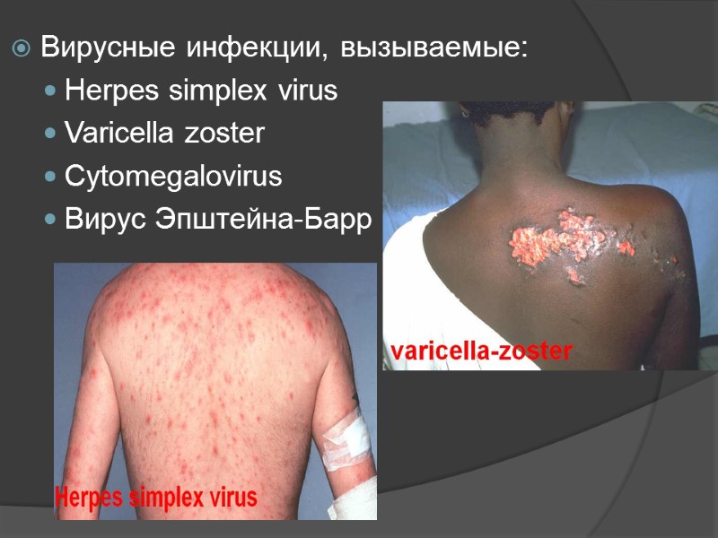 Вирусные инфекции, вызываемые: Herpes simplex virus Varicella zoster  Cytomegalovirus Вирус Эпштейна-Барр